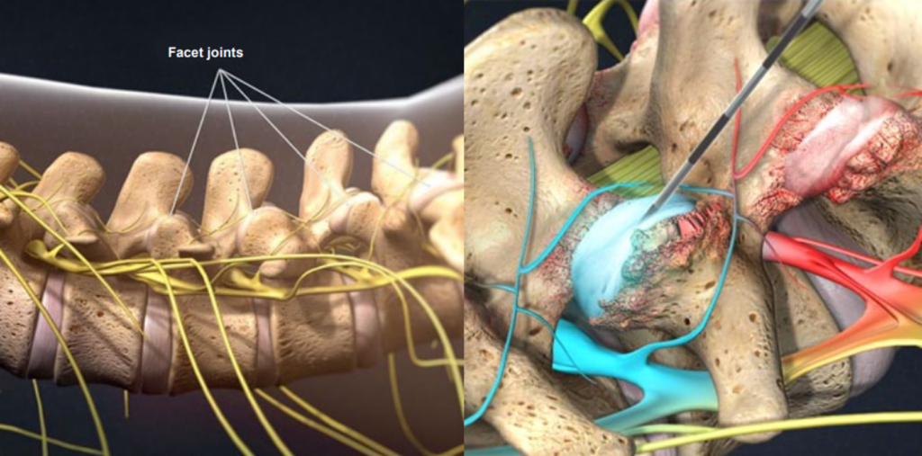 Facet Disease